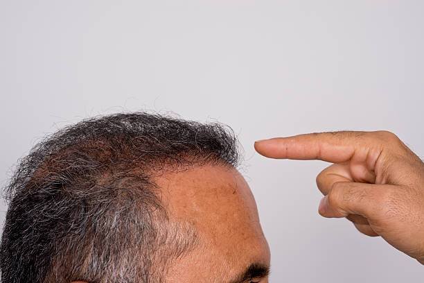 Hair Transplant