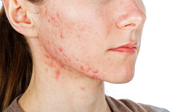 Laser Treatment